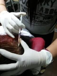 Hair Fall Treatment