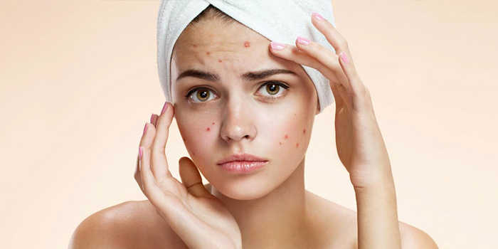 Advanced Pimples & Acne Treatment